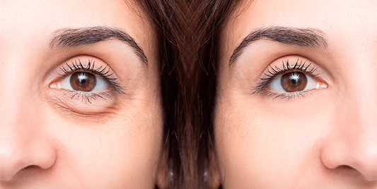 ¿Cómo eliminar y prevenir las ojeras? ¡Te contamos todo lo que necesitas saber!